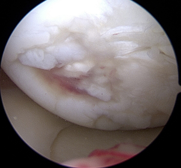 normal cartilage taken with an arthroscopic camera 2