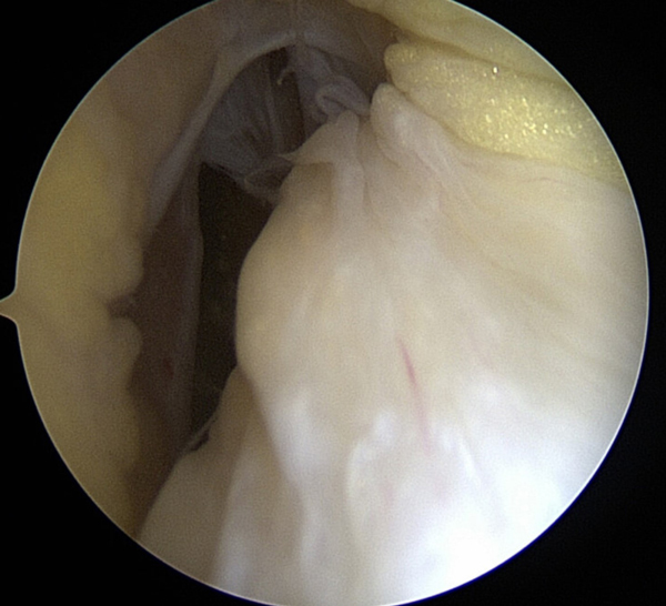 sagittal (View from the side) of an ACL tear