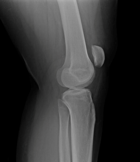 X-ray depicting patella alta