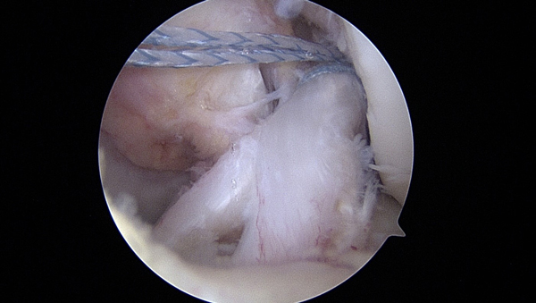 Sutures placed in the ACL 