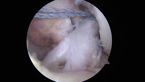 Sutures placed in the ACL