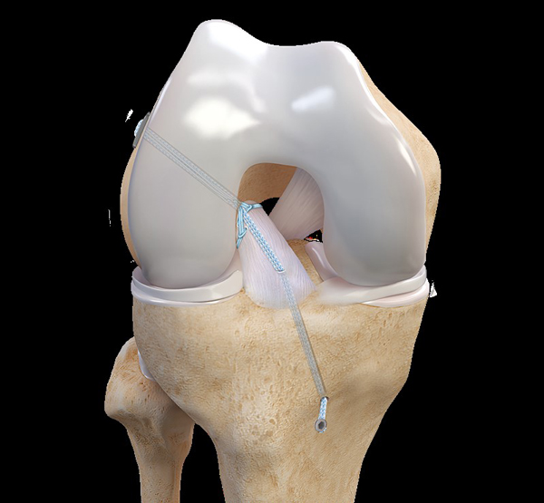 Sutures placed in the ACL