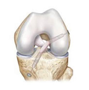 ACL repair surgery