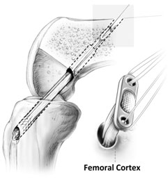 Allograft