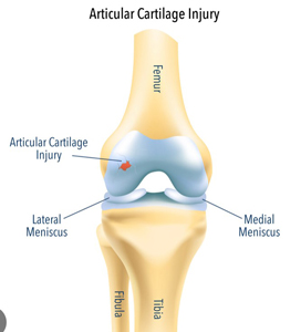 An injury to the surface of the articular cartilage is shown