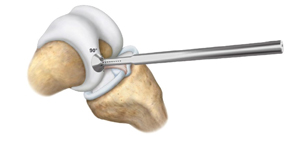 Sizing and Alignment of the articular cartilage