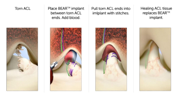 BEAR&reg; Implant procedure 