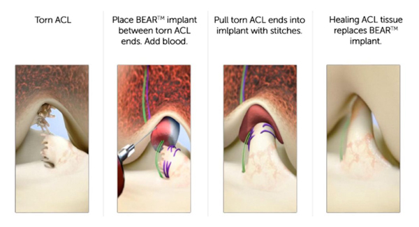 BEAR® Implant procedure 
