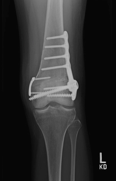 Distal Femoral Osteotomy (DFO)