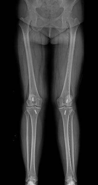 Distal Femoral Osteotomy (DFO)