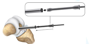 Drill Sleeve for the implantation site