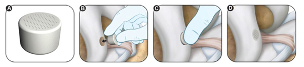 Insertion of the Agili-C Implant