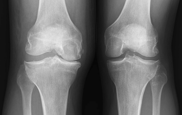 knee x-ray