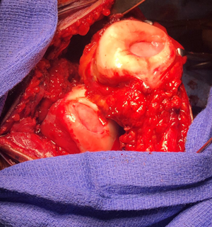 MACI implants have been placed one on the trochlea