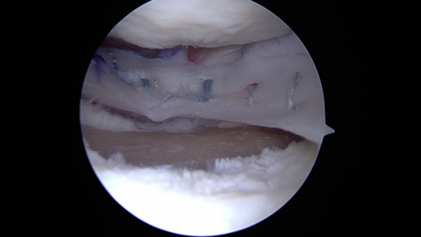 A defect is present underneath a meniscal allograft