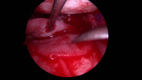 A defect is present underneath a meniscal allograft on the lateral (outside) part of the knee