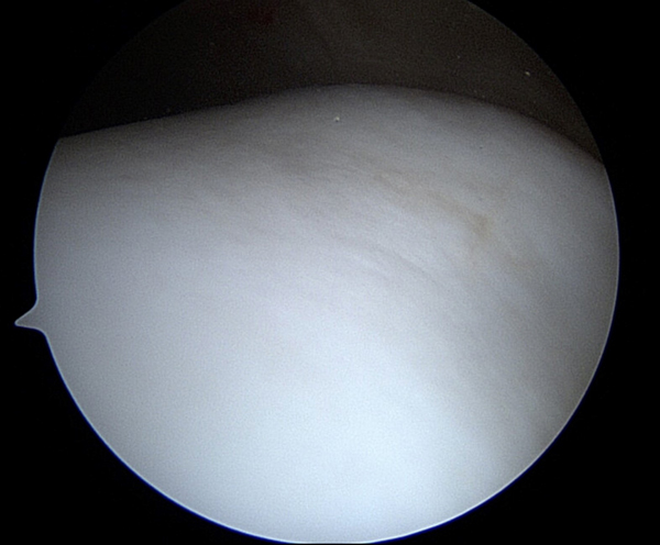 normal cartilage taken with an arthroscopic camera