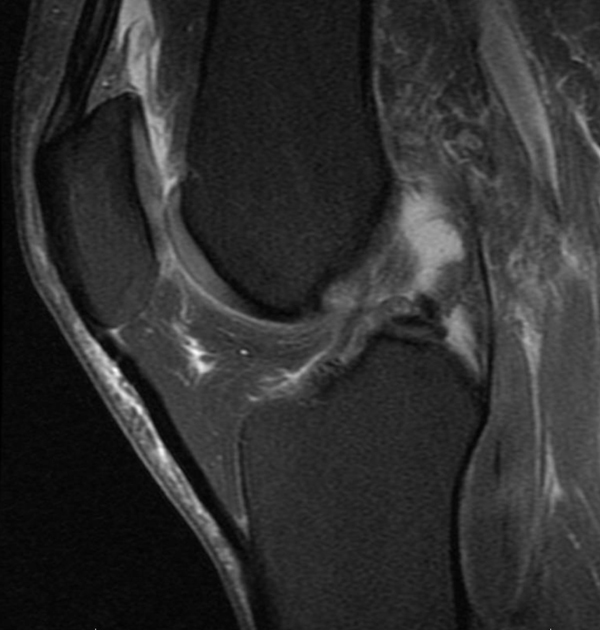 Primary ACL Repair Xray