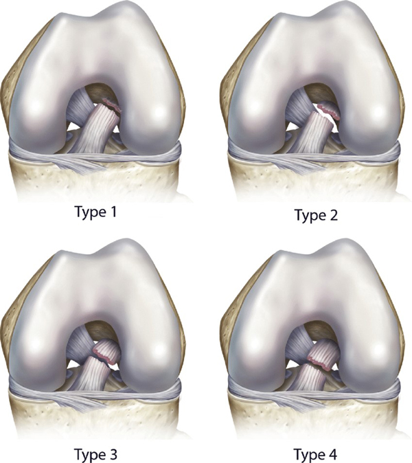 Primary ACL Repair