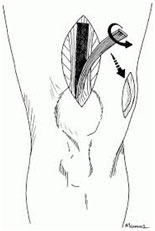 Quadriceps tendon