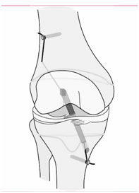 Quadriceps tendon 3