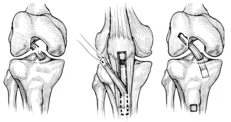 Quadriceps tendon 2