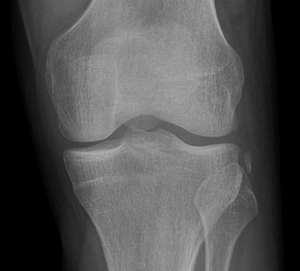 Segond Fracture