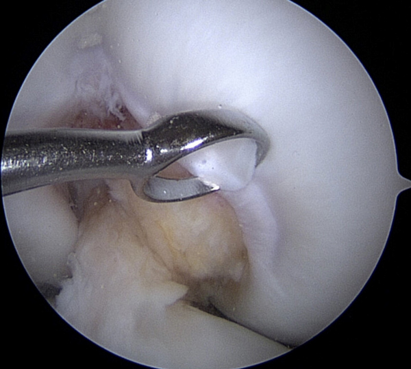 This shows a small curette taking a sample of healthy cartilage