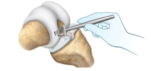 Trimming the peripheral cartilage