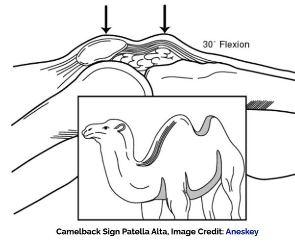 camelback Sign Patella alta