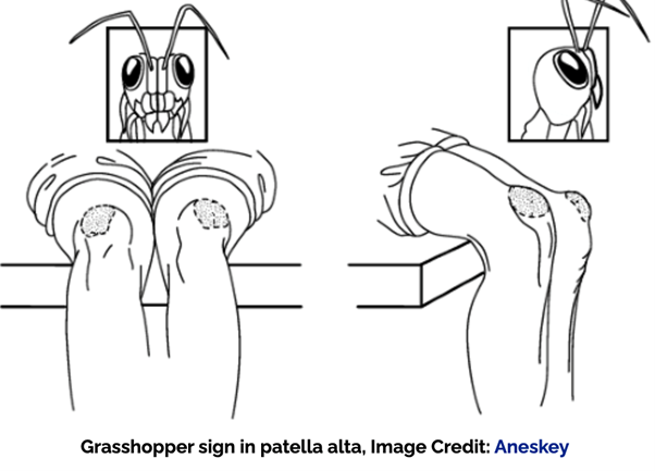 Grasshopper Sign Patella alta