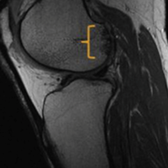 large posterolateral femoral condyle osteochondral lesion.