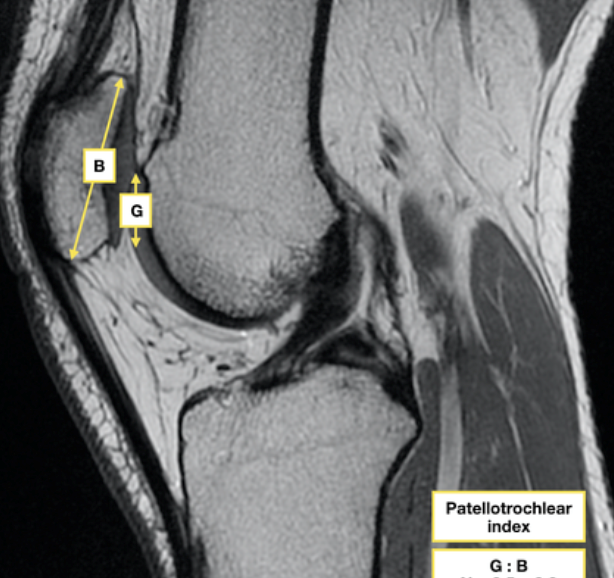 Radiographic measurement used to diagnose patella alta
