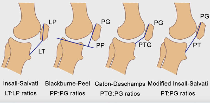 Radiographic measurements used to diagnose patella alta