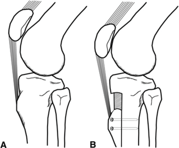 Distalizing tibial tubercle osteotomy moving the patella down to its correct positioning