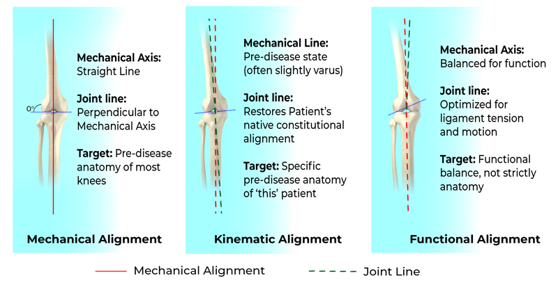Different Alignment Strategies in Total Knee Replacement image